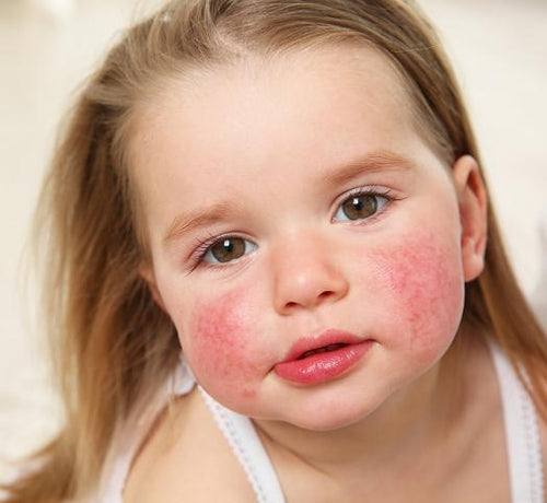Enfant fille blonde avec les joues rouges ayant de l' eczéma atopique - Mustela Benelux - 1
