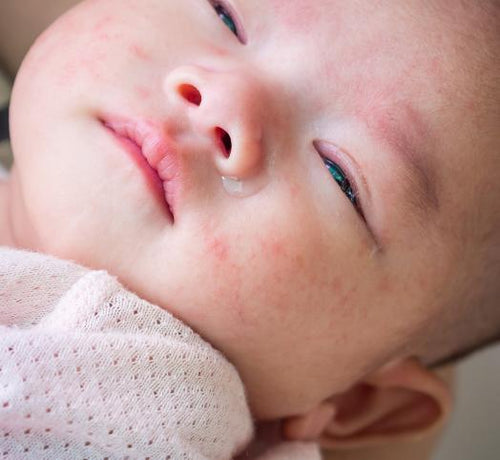 Visage bébé avec un peau atopique qui pleure  - Mustela Belgium - 1