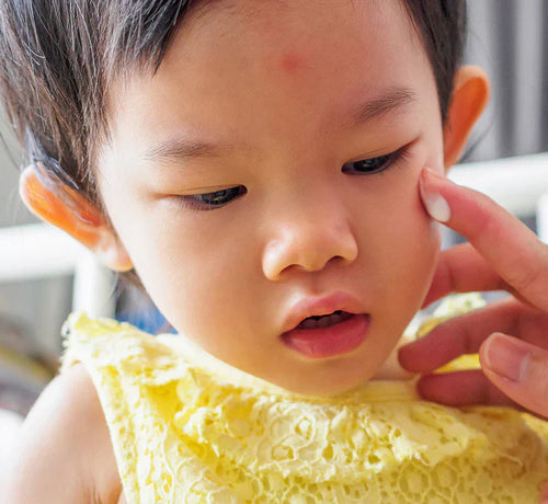 Comment soulager les démangeaisons de l’eczéma ? - Mustela Belgium - 1